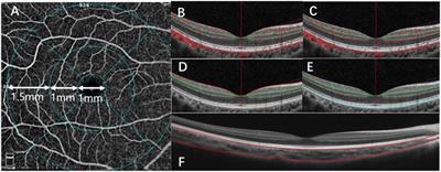 Contrast Sensitivity Is Associated With Chorioretinal Thickness and Vascular Density of Eyes in Simple Early-Stage High Myopia